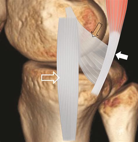 test to identify tears of the joint capsule|Five Overlooked Injuries on Knee MRI .